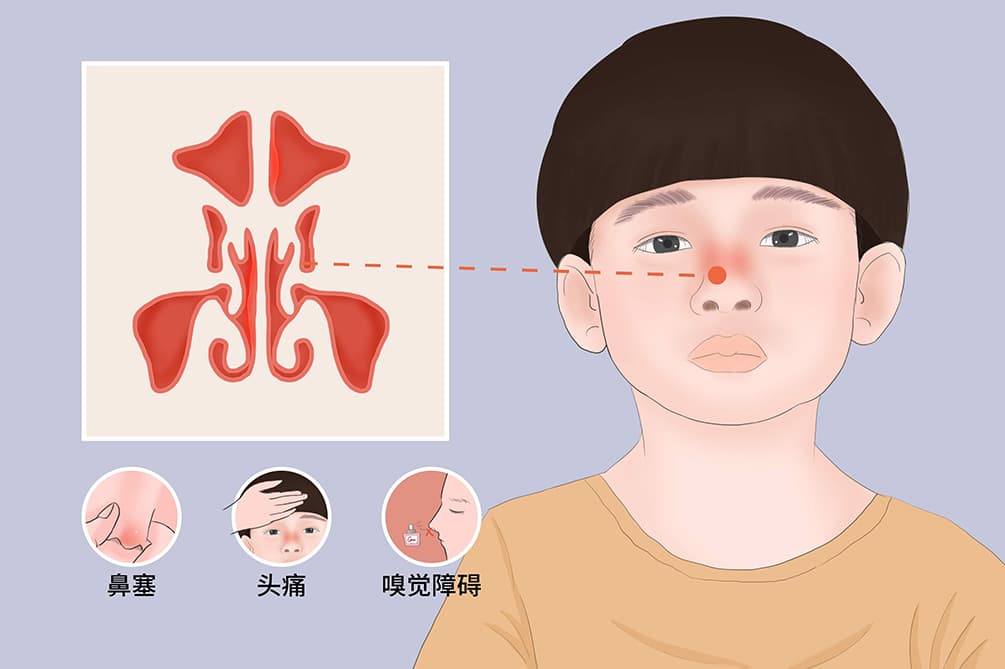 治疗鼻窦炎的民间5种小偏方