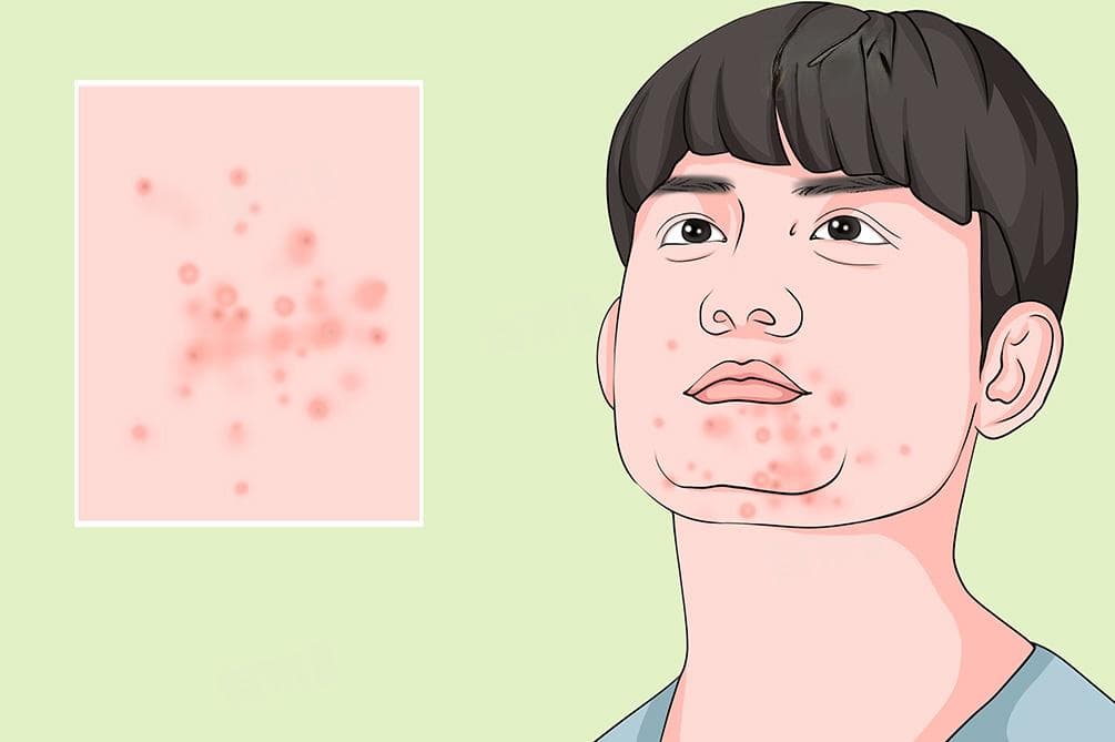 怎样让痘痘快速消退