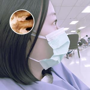 甲泼尼龙导致的视力模糊