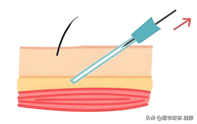 浮针疗法：从筋膜革命到精准医疗的范式突破