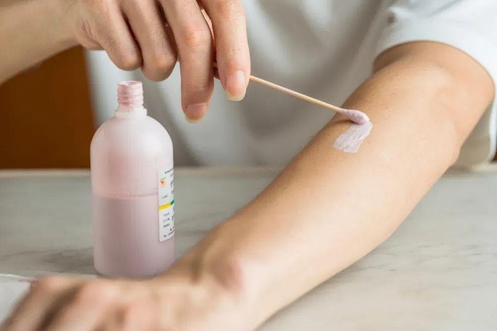 荨麻疹、蚊子包痒得厉害？家中常备一种药，助你快速止痒