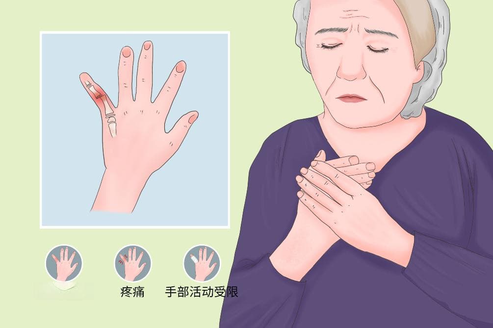 小拇指骨折的分类与处理方法