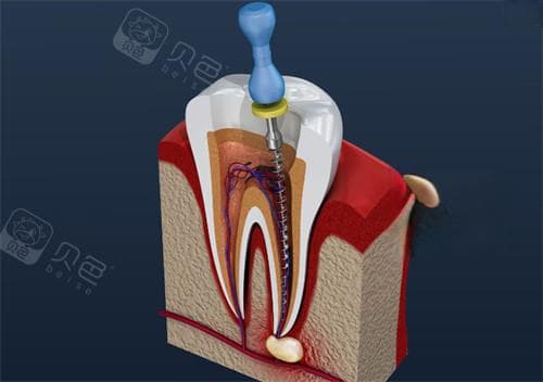 蛀牙断掉后牙根怎么处理？根管治疗、残根牙拔除是比较常见的治疗方式！