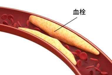 血栓防治全攻略：从认识血栓到科学预防