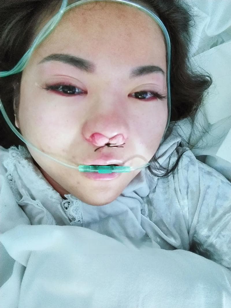 鼻炎手术术后冰敷时间及注意事项