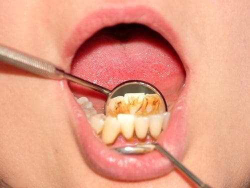 龋齿的发展速度有多快？如何判断深龋是否已经接近牙髓腔？