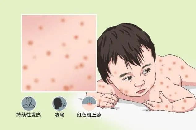 关于麻疹，你知道多少？