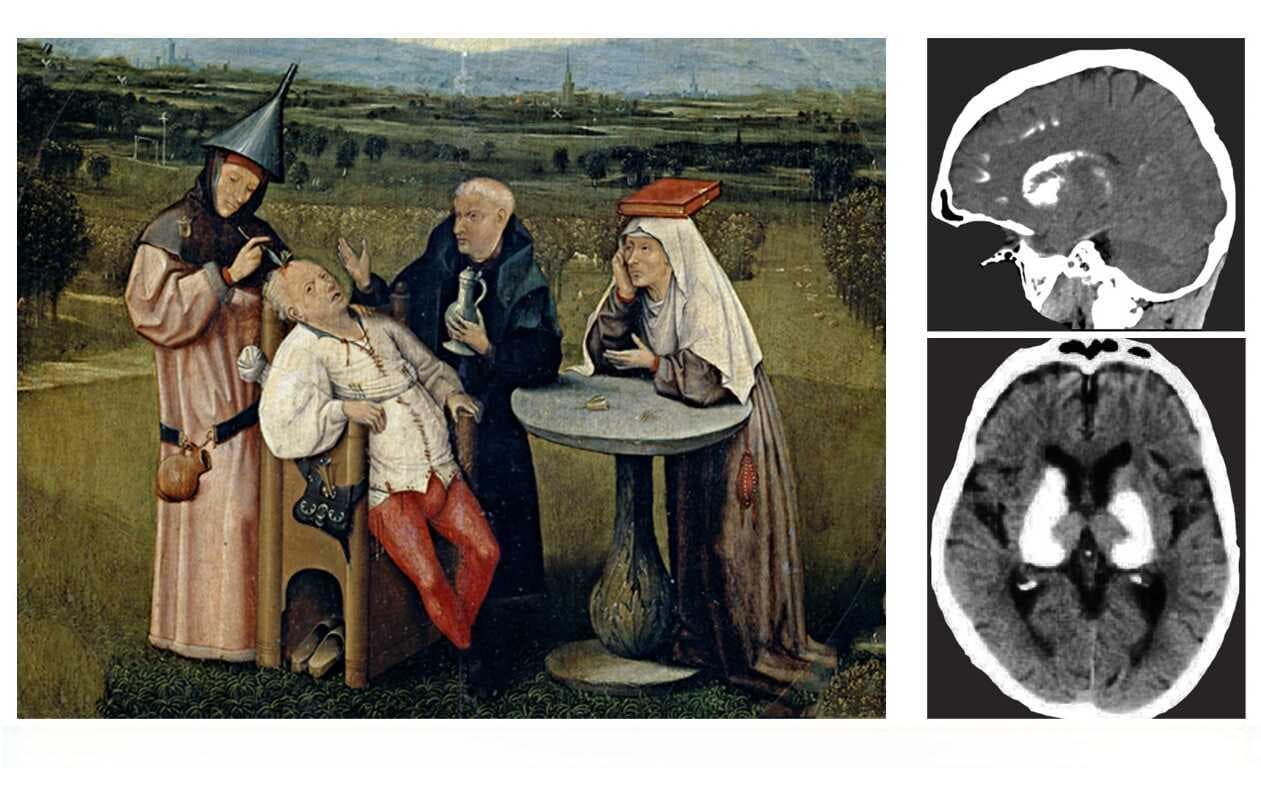 熊志奇组解析“疯狂之石”---脑钙化症的分子与细胞机制