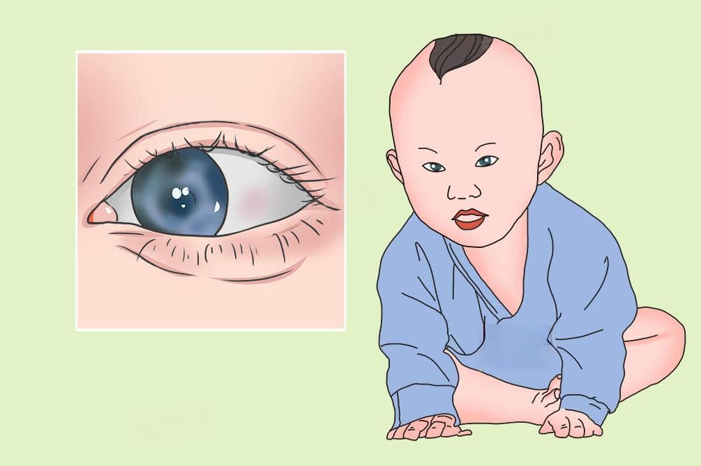 婴儿眼睛老是流泪是怎么回事