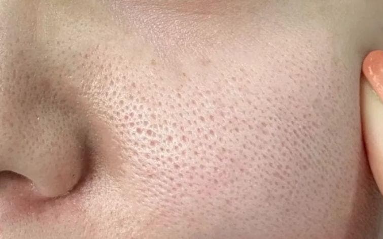 想要告别毛孔粗大，需要做好以下几点