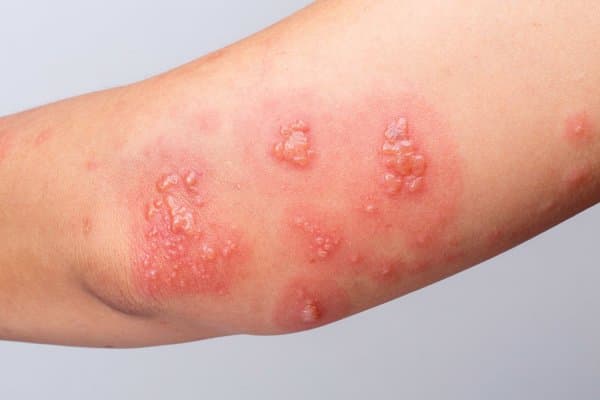 胆碱性荨麻疹是什么？症状、检查与治疗方法全解析
