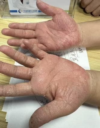 春节狂做家务，“主妇手”来袭，专家称类似病例节后尤为常见