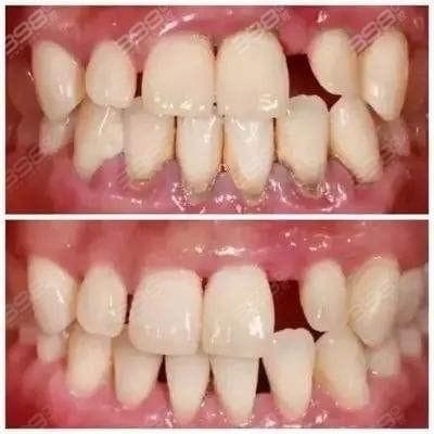 牙周探诊深度分级分析：什么程度需要龈下刮治？