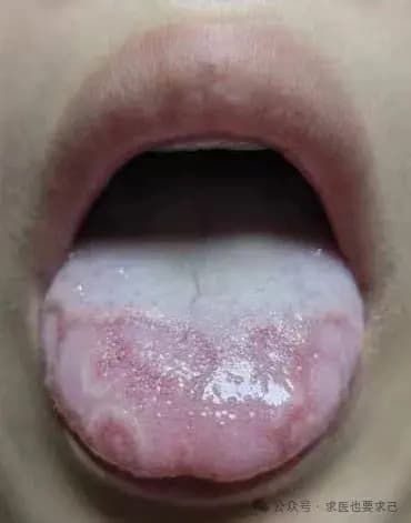 地图舌深度解析：滥用药物与寒湿之困，中医揭秘病因与调理之道