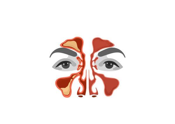 筛窦炎和鼻窦炎有什么区别和症状
