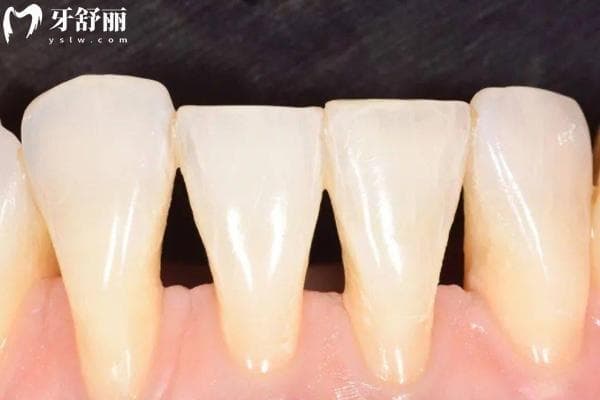 牙齿变长怎么办？门牙下牙后槽牙伸长的解决方案整理