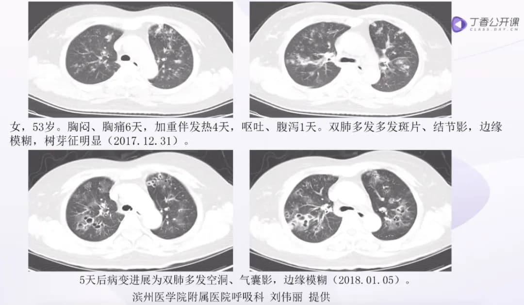 快速鉴别：肺部各类感染CT影像特征