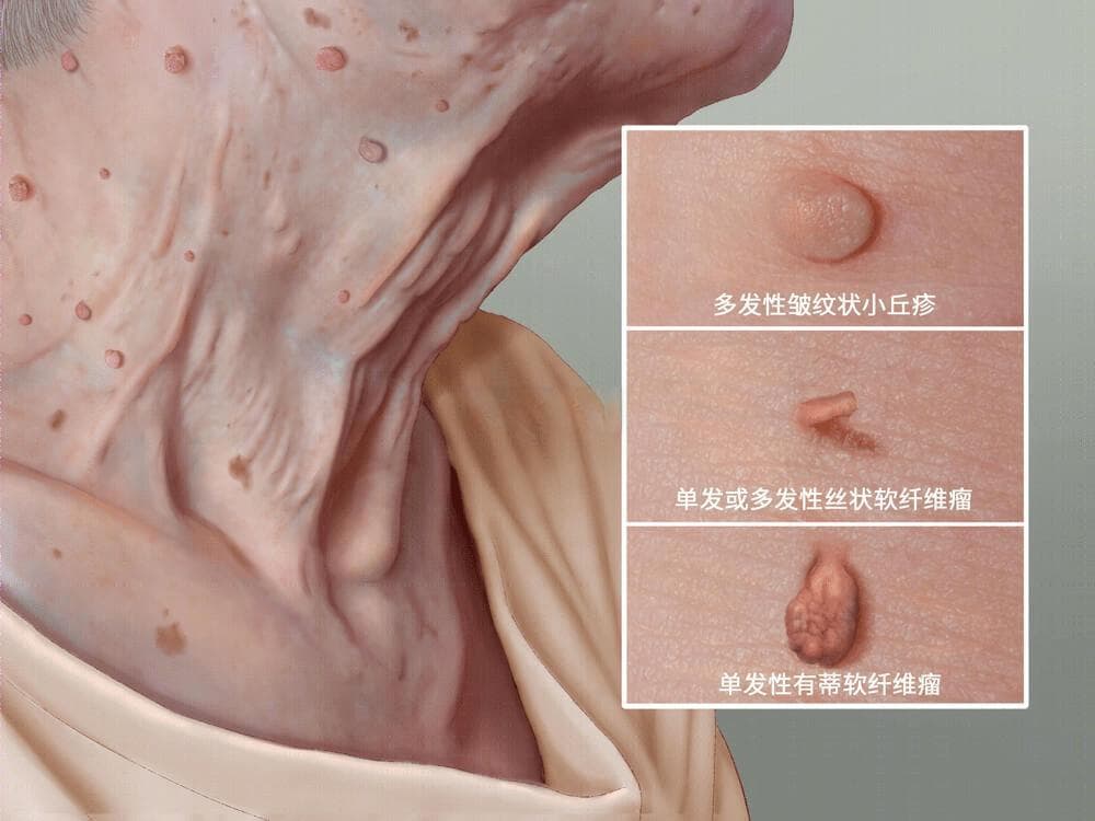 脖子上长出“小肉粒”，可能是这2个问题