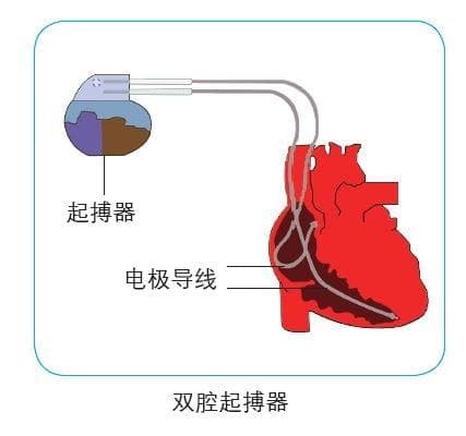 心脏起搏器：守护心跳的“隐形保镖”
