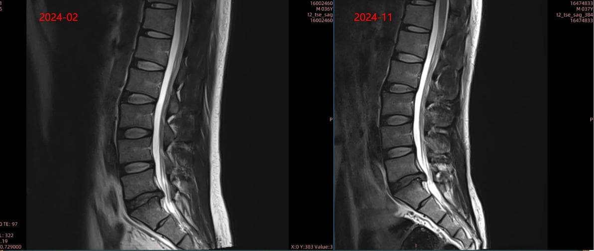 腰椎间盘突出症MRI/CT复查时机