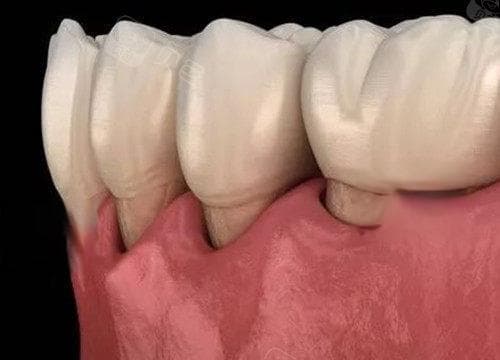 30多岁发现牙龈萎缩要怎么治疗？解析牙龈萎缩成因与高效修复策略