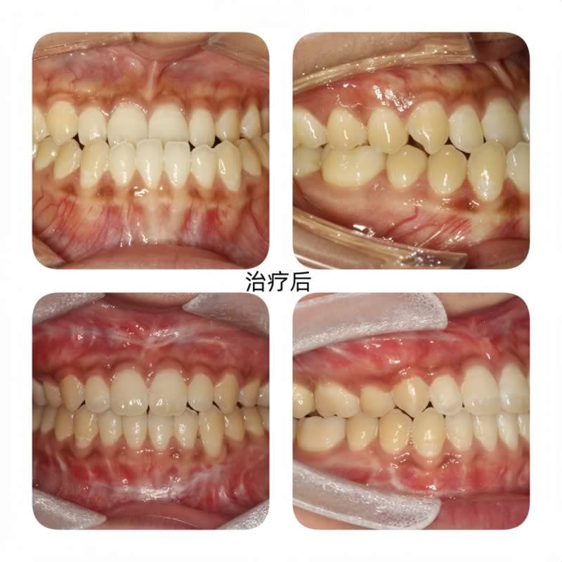 什么是正畸-正颌联合治疗？