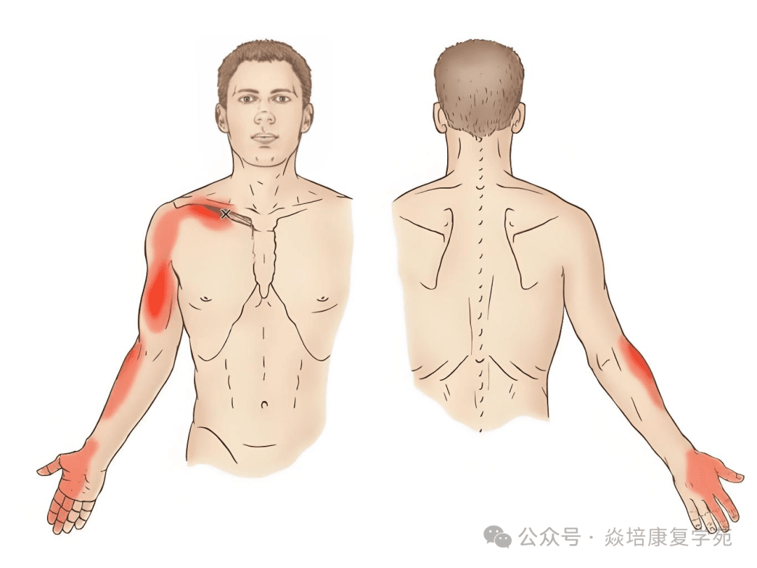 锁骨下肌激痛点与肋锁综合征