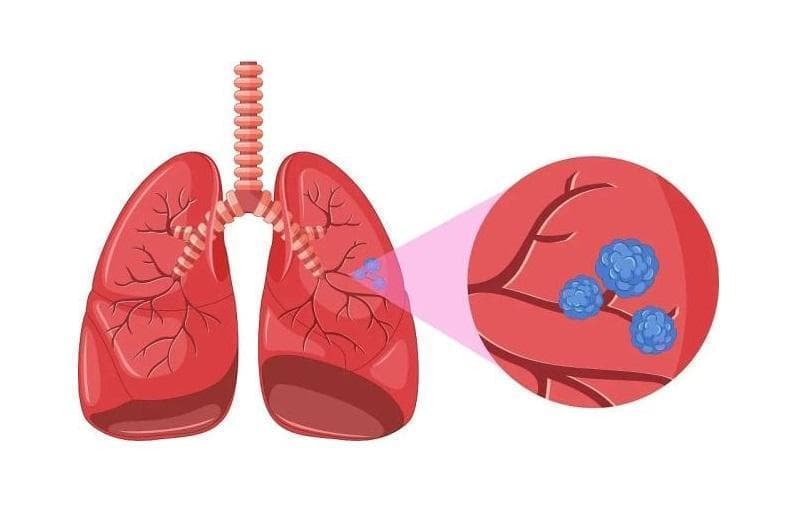 肺结节的恶变概率：科学解读与风险管理