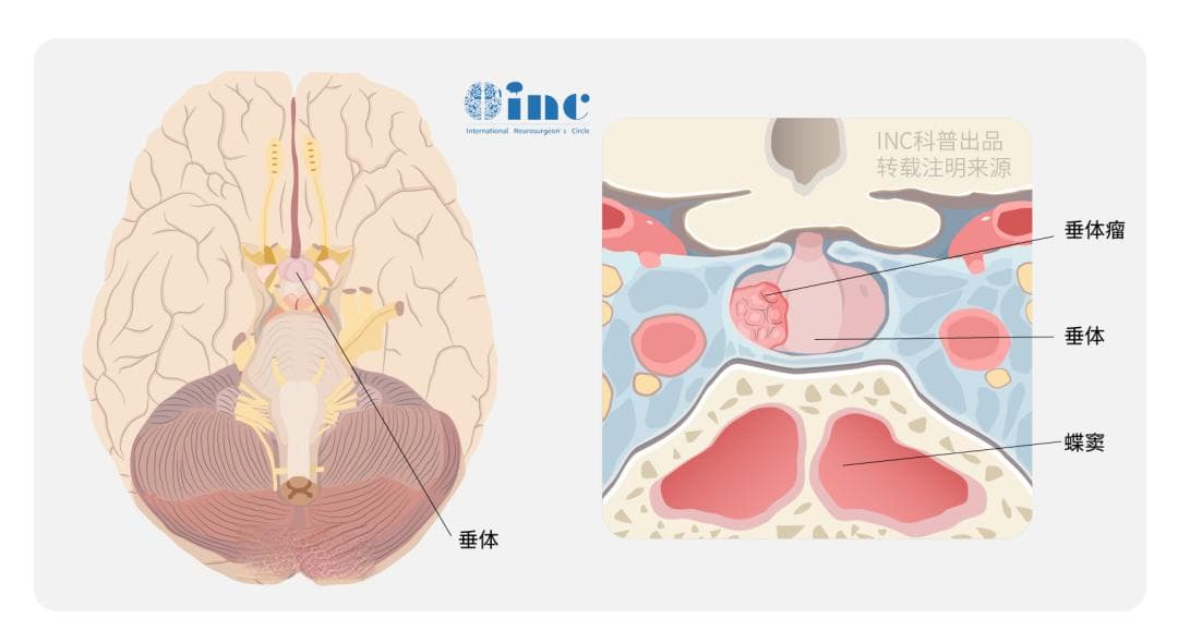 揭秘大脑的“不速之客”：垂体瘤的那些事儿，你了解多少？