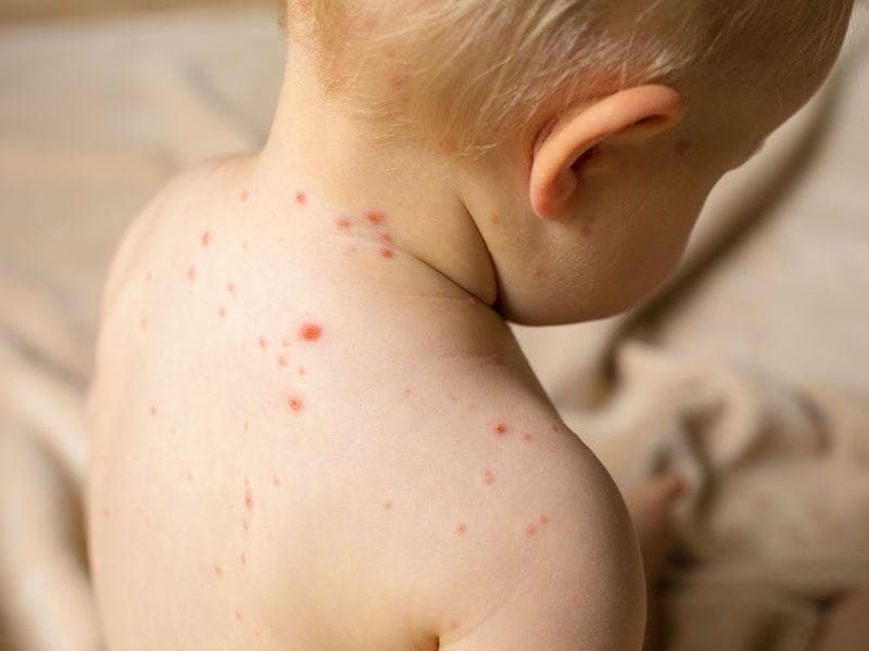 宝宝疹子全解析：6种常见疹子的症状、原因与预防方法