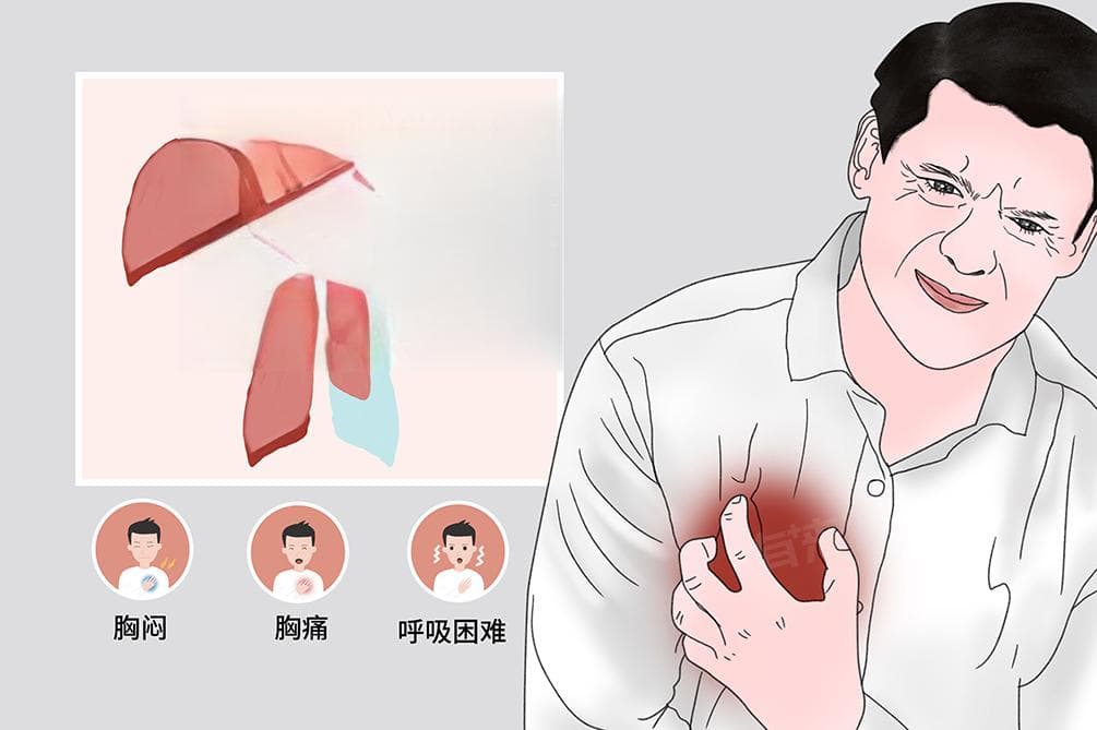 气胸早期症状及表现
