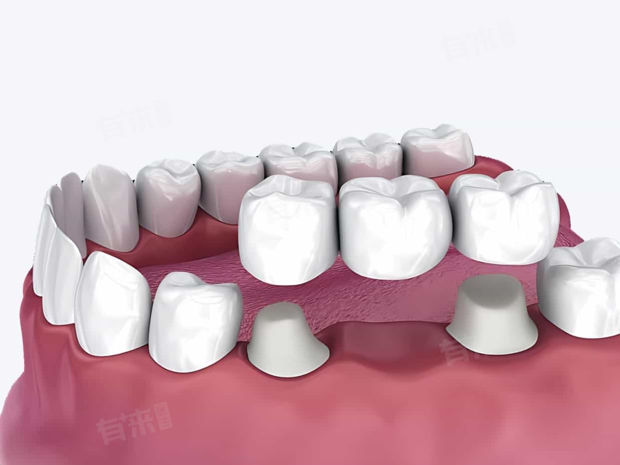 成人牙齿掉了一颗怎么处理