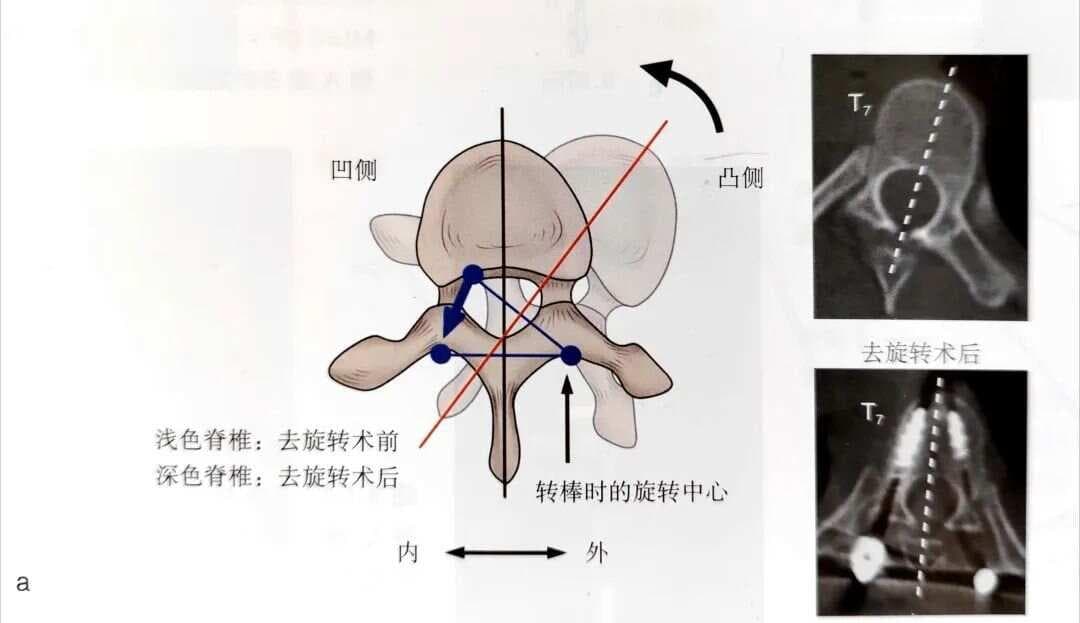 常见的脊柱矫形技术中的生物力学原理