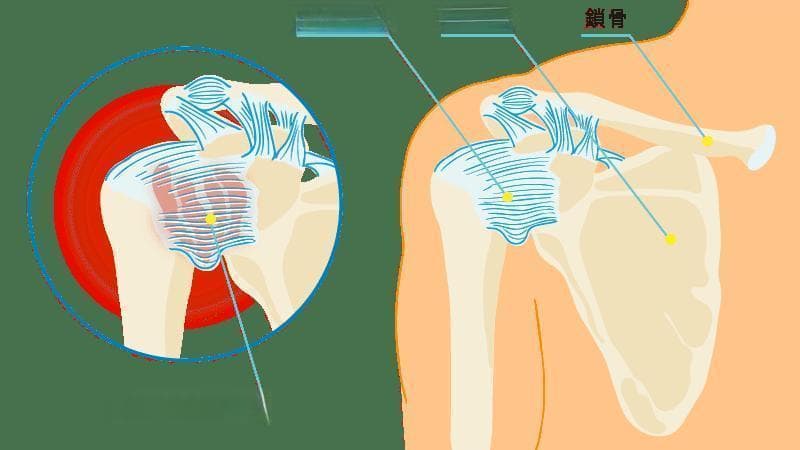 五十肩是什么？了解症状成因、治疗方法及康复运动改善症状