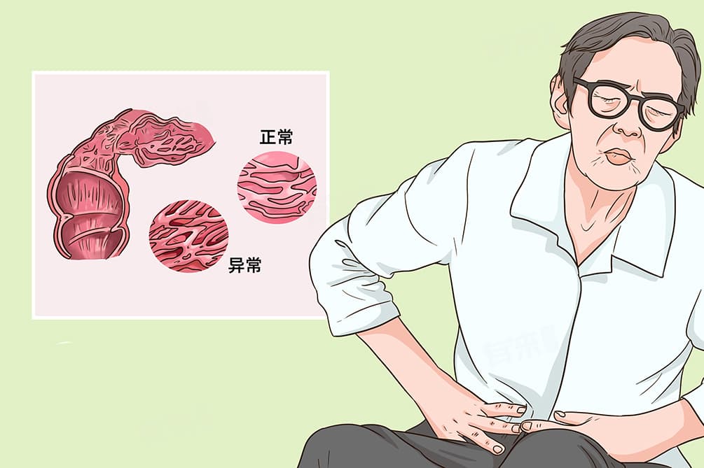 慢性肠炎的成因及日常注意事项