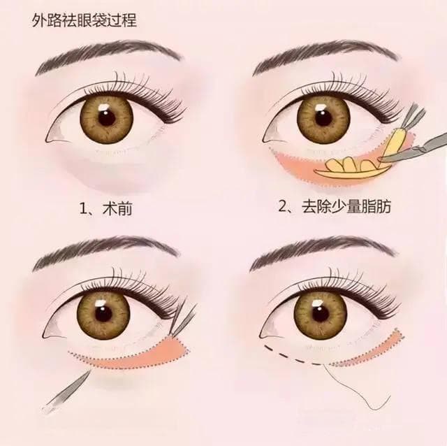 整形医生王耀聪：解析眼袋的成因、预防和改善方法