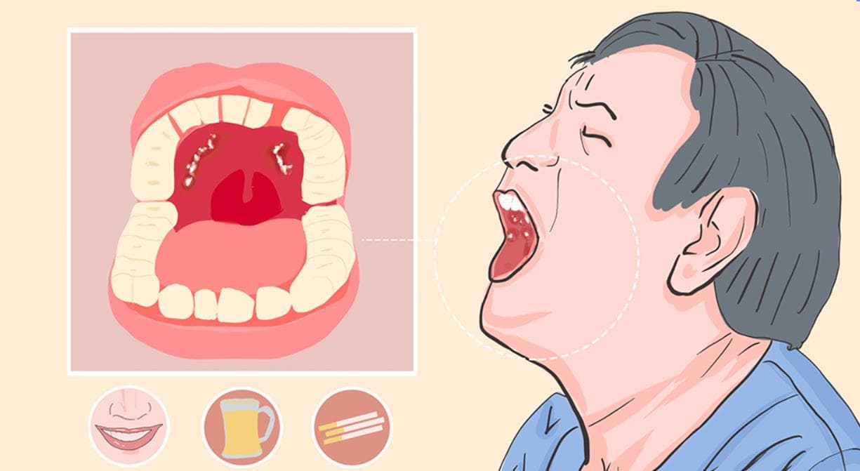 怎么判断是不是口腔癌