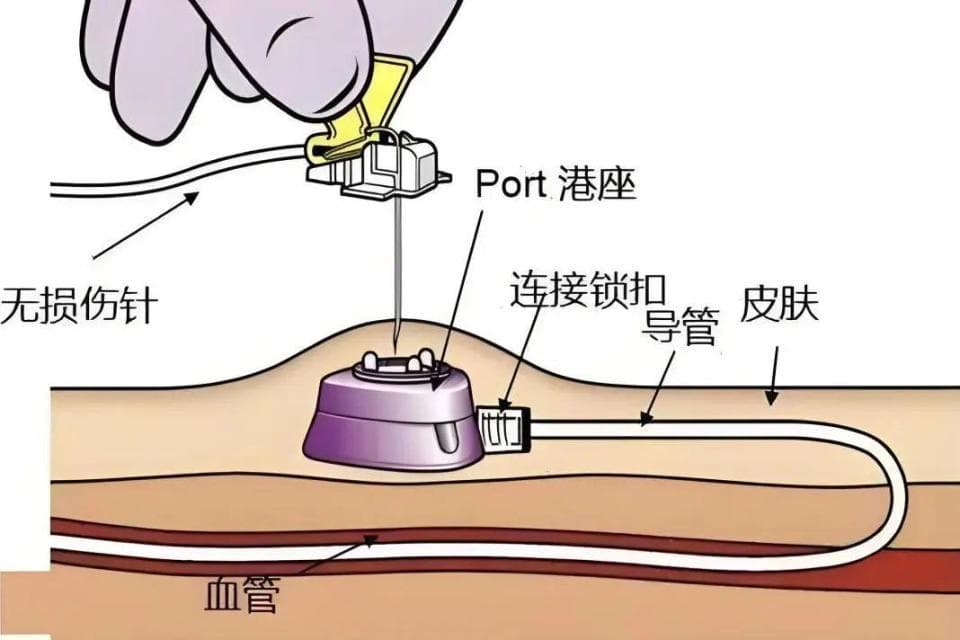 一种更“体贴”的输液方式——“输液港”