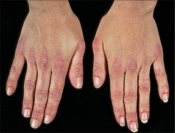 皮肌炎健康宣教：症状、诊断与治疗全解析