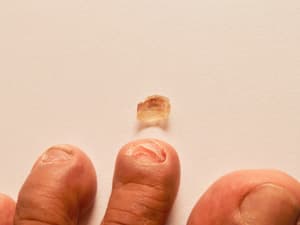大拇指指甲中间凸起怎么回事