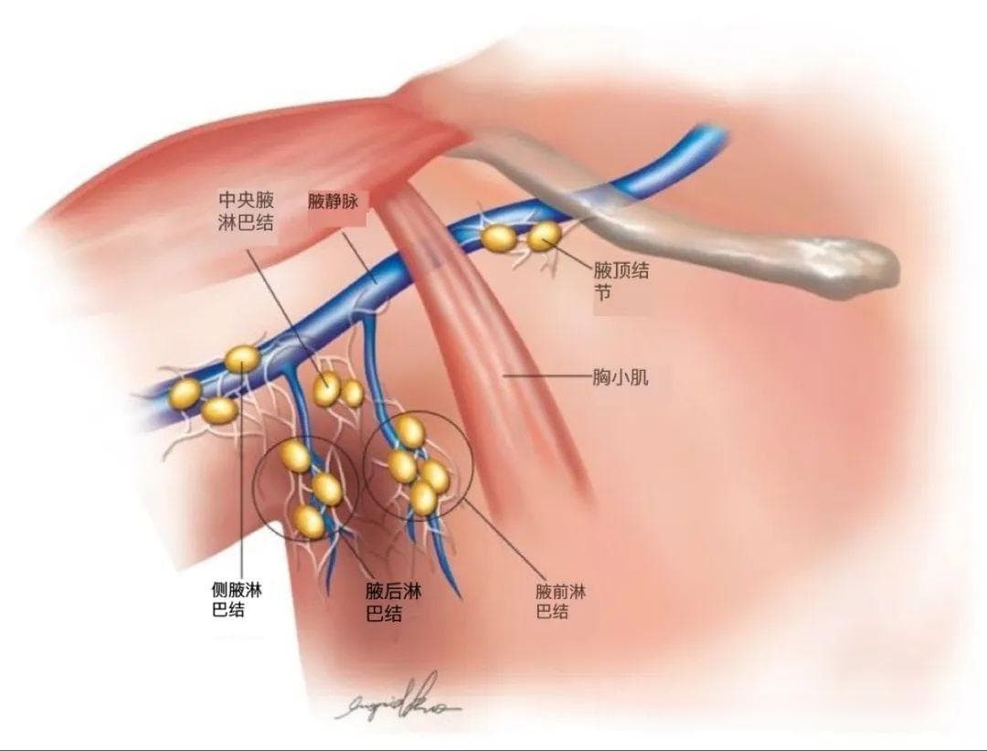 【淋巴结影像解剖系列】---腋窝淋巴结解剖及分区