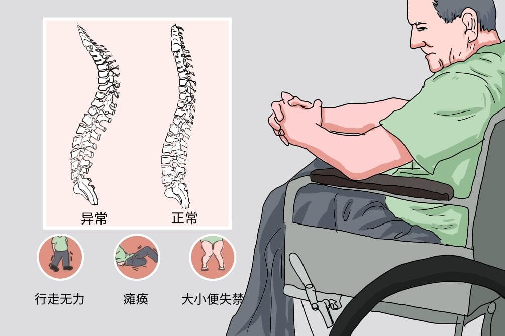 脊柱结核的就医指征是什么？