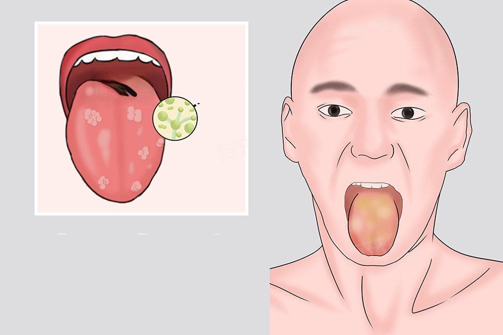 念珠菌是什么意思