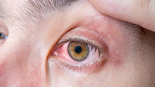 干眼症用蒸汽熏眼睛可以吗