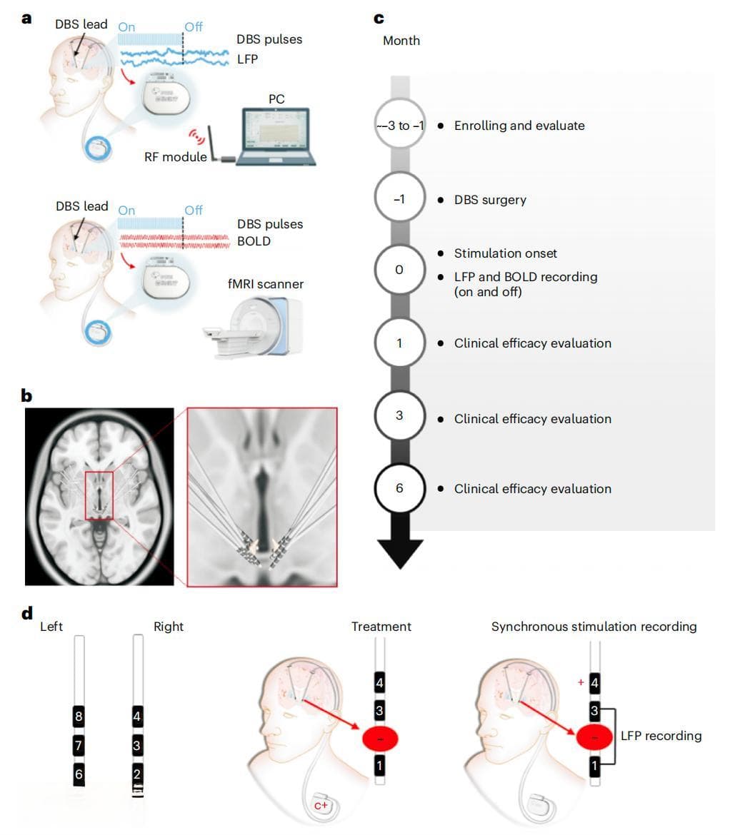 双侧缰核脑深部电刺激，可显著改善难治性抑郁症患者症状