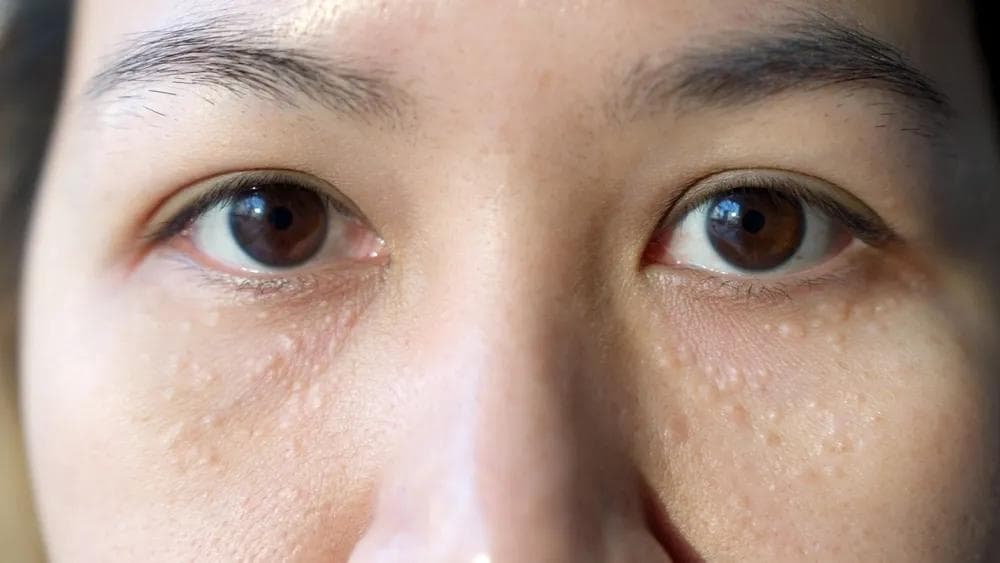 眼睛周围小颗粒，不一定都是脂肪粒，4种常见情况一篇说清