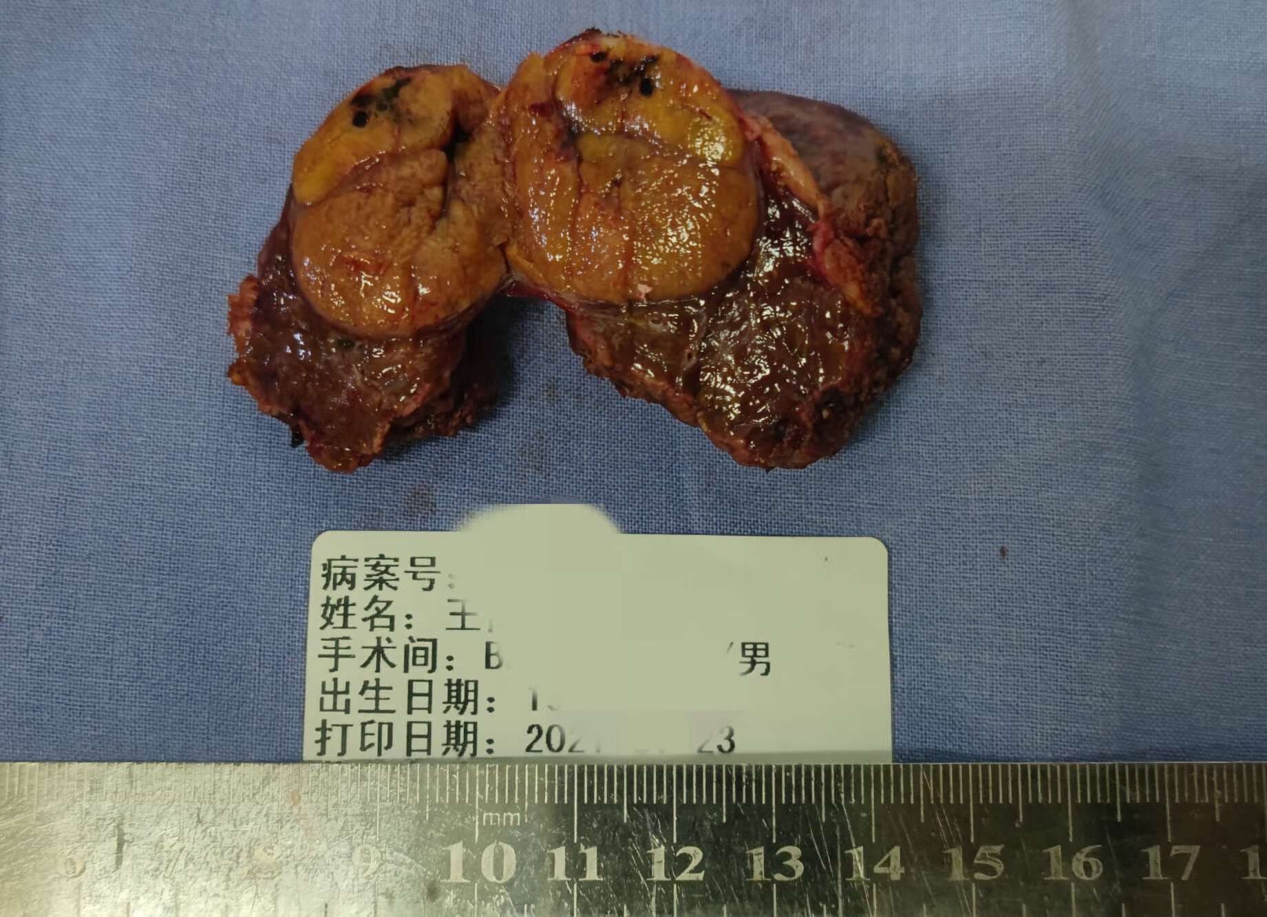 腹腔镜微创手术切除肝癌创伤小、恢复快！