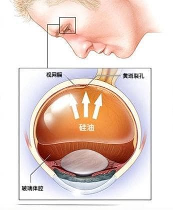 当被遗忘的眼内硅油成为“定时炸弹”