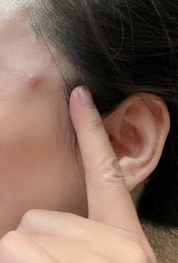 疖：定义、症状、病因与治疗方法全解析