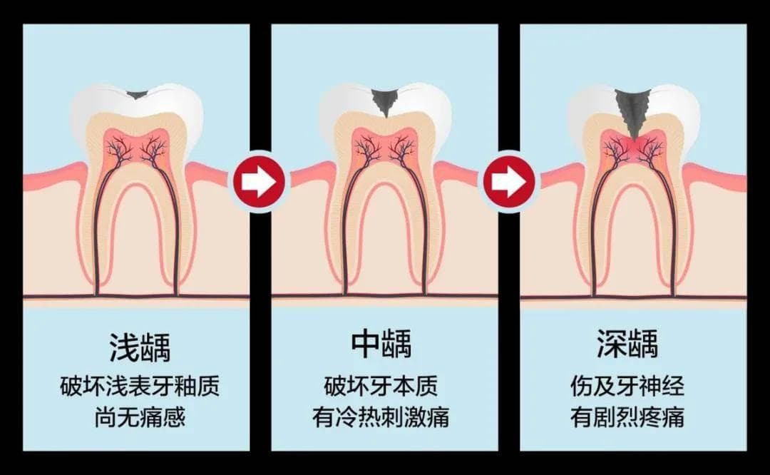 蛀牙一定要补吗？四种需要补牙的情况一定要知道，否则最后不仅遭罪还费钱